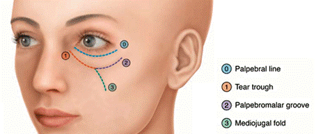 Preenchimento de olheira com ácido hialurônico medico dermatologista sp