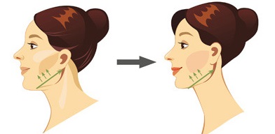 Botox para pescoço e colo com toxina botulínica Botox para pescoço e colo com toxina botulínica
