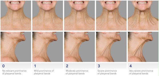 Botox para pescoço e escala de envelhecimento do colo Botox para pescoço e escala de envelhecimento do colo