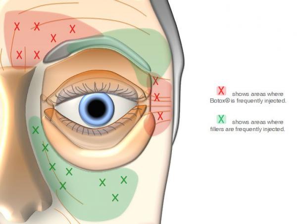 Áreas de aplicação de toxina e áreas de preenchimento com ácido hialurônico