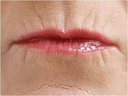 botox para rugas no lábio e boca em linhas periorais