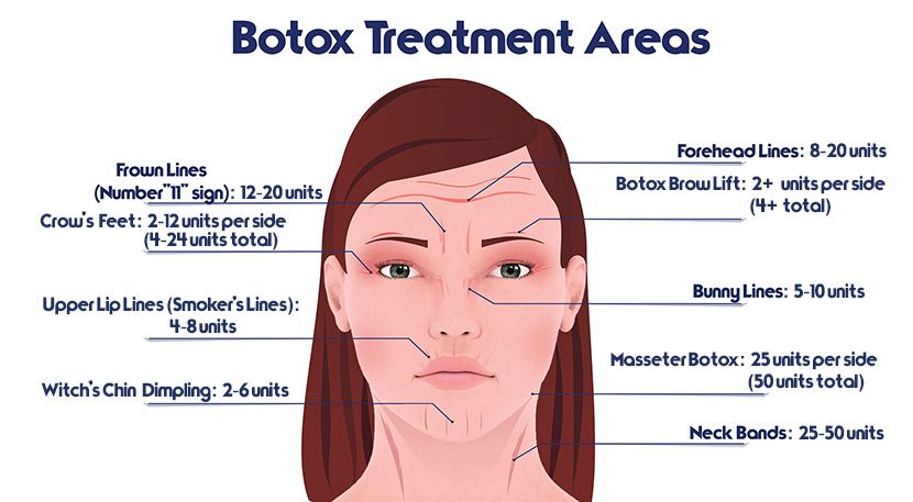botox-tratamento Osasco aplicação de toxina botulínica