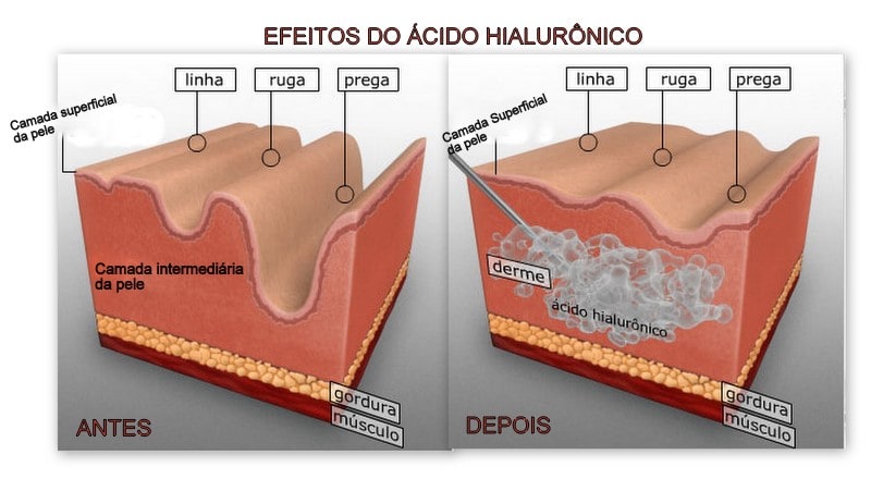 Aplicacao acido hialuronico sp Sao Paulo - Injectors (6)