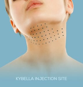 aplicacao de acido Kybella - Desoxicolato de Sodio - Injectors