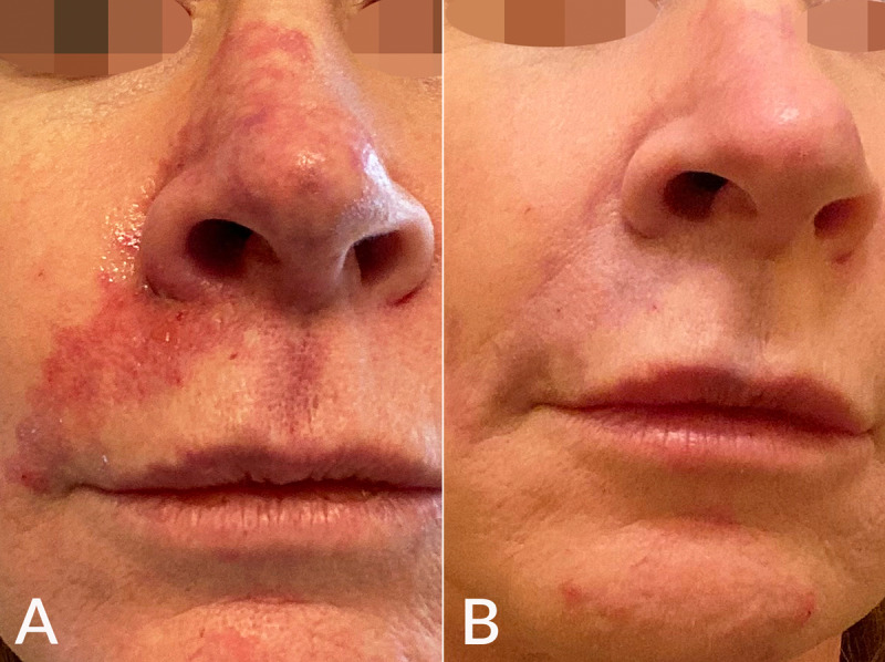 segurança na aplicação de botox e preenchimento segurança na aplicação de botox e preenchimento